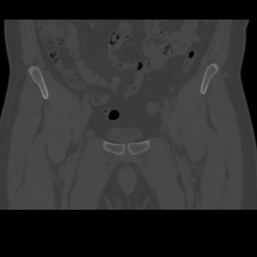 File:Avascular necrosis of the hip (Radiopaedia 61503-69467 Coronal bone window 3).jpg