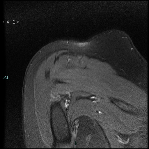 File:Avascular necrosis of the shoulder - Cruess stage I (Radiopaedia 77674-89886 Coronal PD fat sat 2).jpg