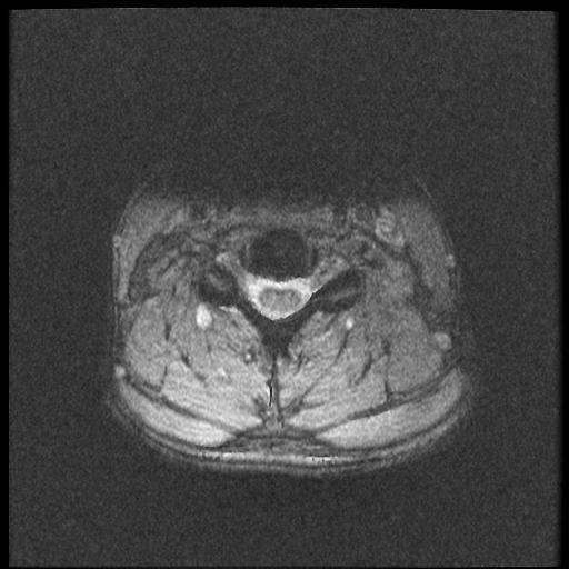 File:Axis fracture - MRI (Radiopaedia 71925-82375 Axial T2 fat sat 14).jpg