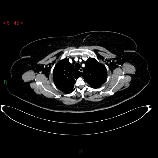 Azygos fissure and lobe (Radiopaedia 47620-52278 A 31).jpg
