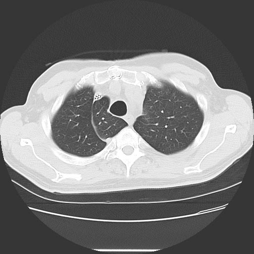 File:Azygos lobe (Radiopaedia 11229-11594 Axial lung window 1).jpg