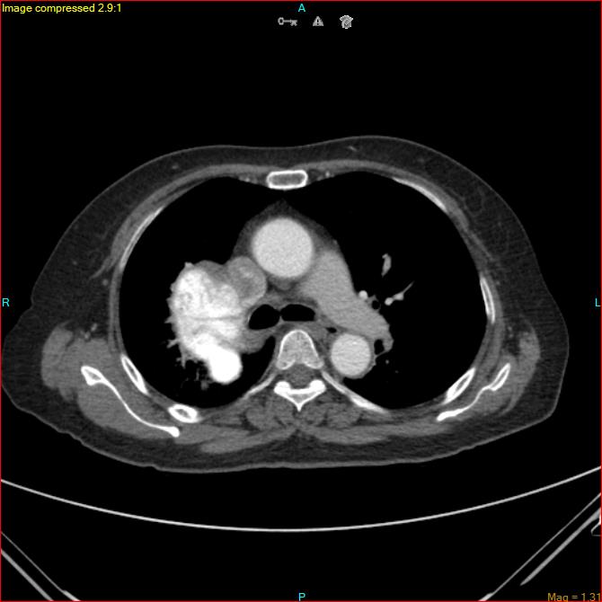 Azygos vein aneurysm (Radiopaedia 77824-90130 B 25).jpg