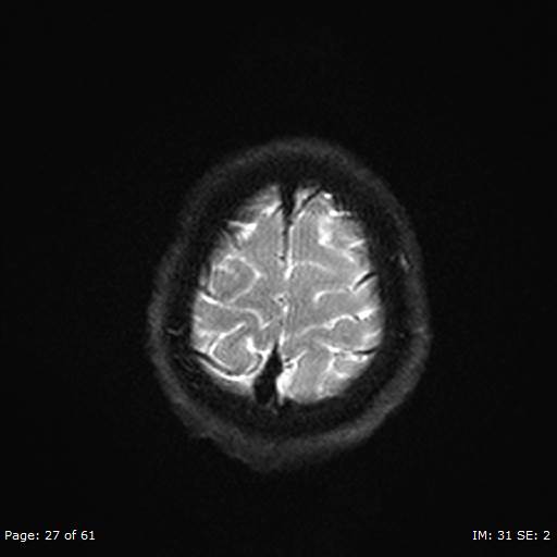 Balo concentric sclerosis (Radiopaedia 61637-69636 Axial DWI 27).jpg