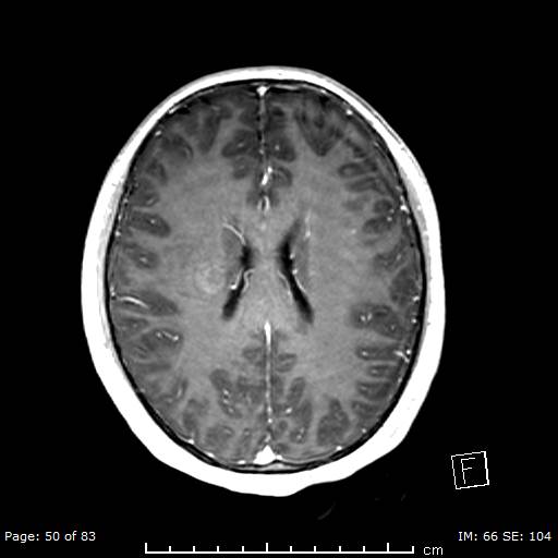 Balo concentric sclerosis (Radiopaedia 61637-69636 Axial T1 C+ 50).jpg