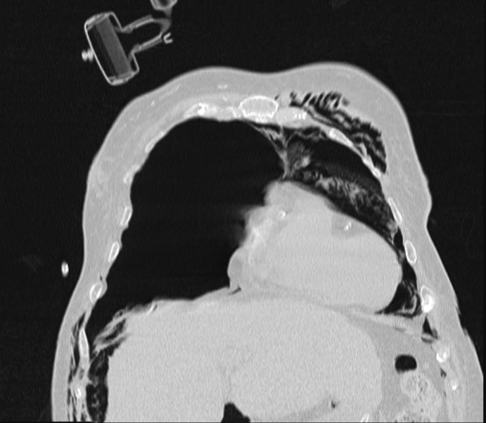 Barotrauma due to mechanical ventilation (Radiopaedia 28079-28336 Coronal lung window 26).jpg