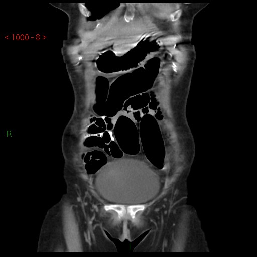 File:Bartholin gland cyst (Radiopaedia 54904-61181 Coronal C+ delayed 8).jpg