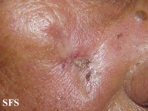 Basal Cell Carcinoma (Dermatology Atlas 104).jpg