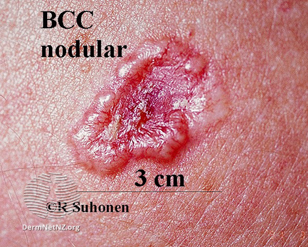 File:Basal cell carcinoma affecting the face (DermNet NZ lesions-bcc-face-0619).jpg