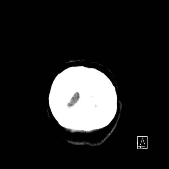 Basal ganglia chronic hypoxic ischemic disease (Radiopaedia 75583-86857 Coronal non-contrast 53).jpg