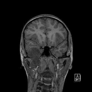 Base of skull rhabdomyosarcoma (Radiopaedia 32196-33142 Coronal T1 15).jpg