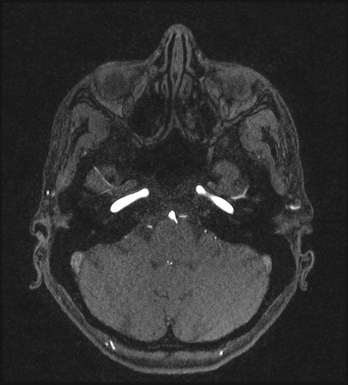 Basilar artery perforator aneurysm (Radiopaedia 82455-97733 Axial MRA 58).jpg