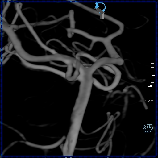 Basilar artery perforator aneurysm (Radiopaedia 82455-99524 3D Left VA 52).jpg