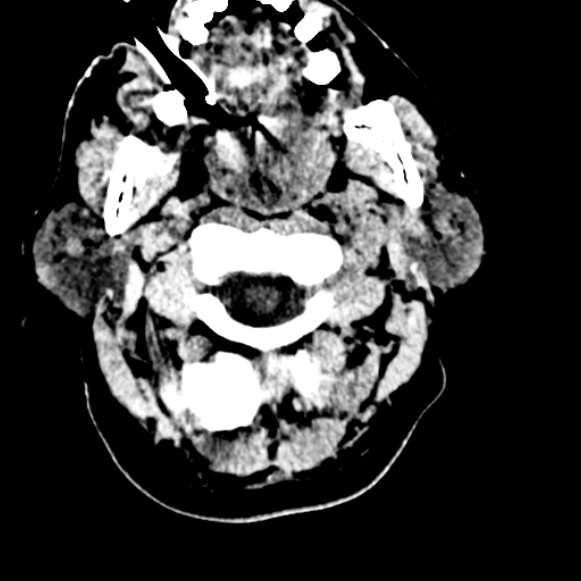 Basilar artery thrombosis (Radiopaedia 53351-59333 Axial non-contrast 11).jpg