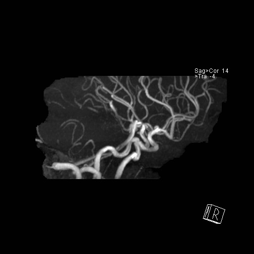 Basilar tip aneurysm (Radiopaedia 26504-26632 D 40).jpg