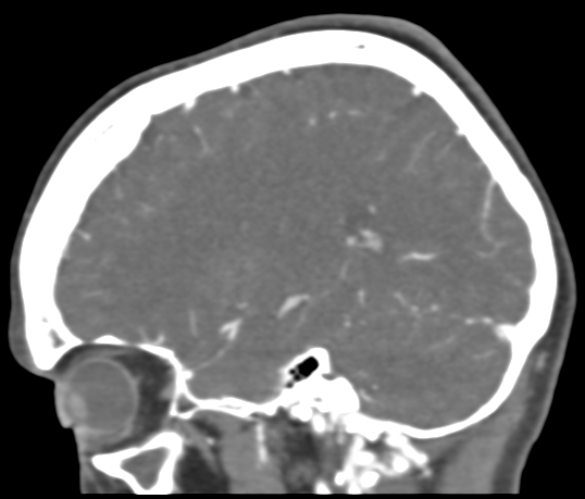 Basilar tip aneurysm with coiling (Radiopaedia 53912-60086 C 92).jpg