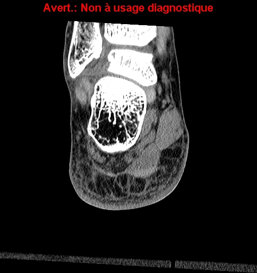 Baxter neuropathy (Radiopaedia 25988-26125 Coronal non-contrast 30).jpg