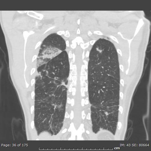 File:Behçet disease (Radiopaedia 44247-47889 Coronal lung window 7).jpg