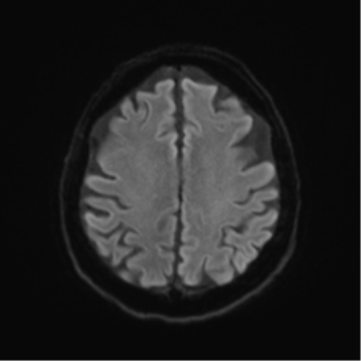 Behavioral variant frontotemporal dementia and late onset schizophrenia (Radiopaedia 52197-58083 Axial DTI Trace W 46).png