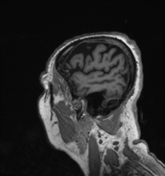 Behavioral variant frontotemporal dementia and late onset schizophrenia (Radiopaedia 52197-58083 Sagittal T1 97).png