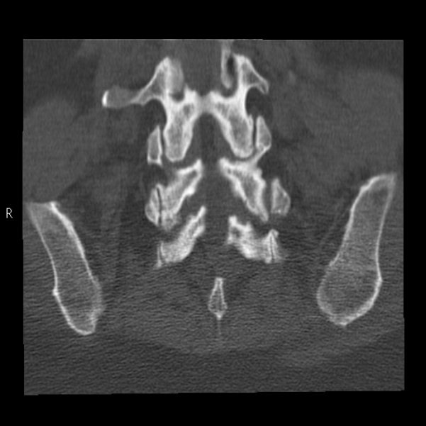 Bertolotti syndrome (Radiopaedia 24864-25128 Coronal bone window 38).jpg