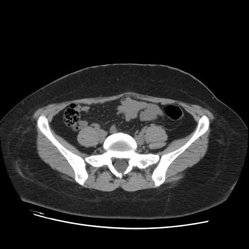 File:Bicornuate uterus (MRI) (Radiopaedia 49206-54296 Axial 20).jpg