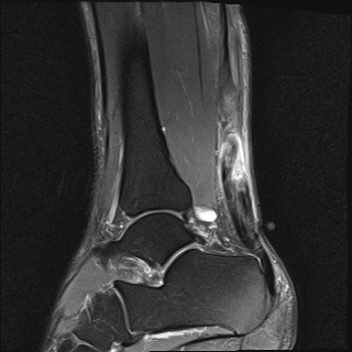 File:Bilateral Achilles tendon complete tear (Radiopaedia 81344-95051 Sagittal T2 fat sat 7).jpg