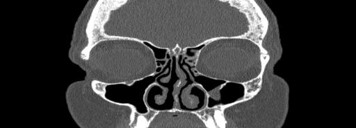 File:Bilateral Ectopic Infraorbital Nerves (Radiopaedia 49006-54084 Coronal bone window 19).jpg