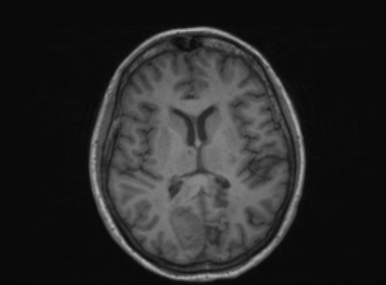 Bilateral PCA territory infarction - different ages (Radiopaedia 46200-51784 Axial T1 221).jpg