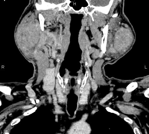 File:Bilateral Warthin tumors (Radiopaedia 84034-99263 C 24).jpg