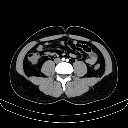 Bilateral accessory renal arteries with mild pelvi-ureteric junction (PUJ) obstruction (Radiopaedia 66357-75596 A 39).jpg