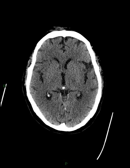 Bilateral acute middle cerebral artery territory infarcts (Radiopaedia 77319-89401 Axial non-contrast 41).jpg