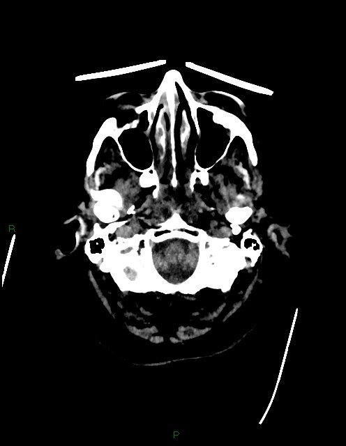 Bilateral acute middle cerebral artery territory infarcts (Radiopaedia 77319-89401 Axial non-contrast 7).jpg