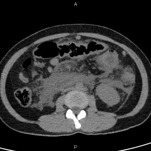 Bilateral adrenal gland hyperenhancement in pancreatitis (Radiopaedia 86642-102753 Axial non-contrast 59).jpg