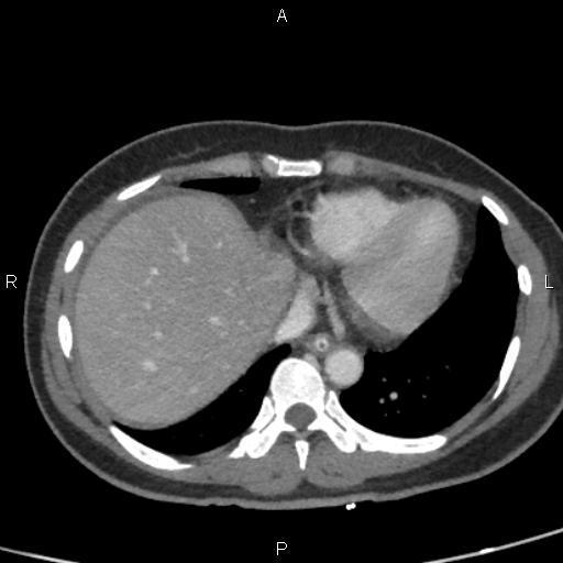 Bilateral adrenal gland hyperenhancement in pancreatitis (Radiopaedia 86642-102753 E 7).jpg