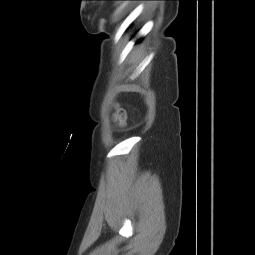 Bilateral adrenal granulocytic sarcomas (chloromas) (Radiopaedia 78375-91007 C 23).jpg
