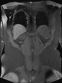 Bilateral adrenal myelolipoma (Radiopaedia 63058-71537 Coronal T1 fat sat 18).jpg