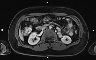 Bilateral adrenal myelolipoma (Radiopaedia 63058-71537 G 51).jpg