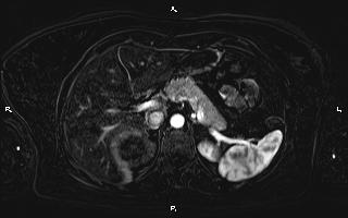 Bilateral adrenal myelolipoma (Radiopaedia 63058-71537 I 31).jpg