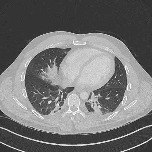 Bilateral atelectasis (Radiopaedia 48666-53675 Axial lung window 75).jpg