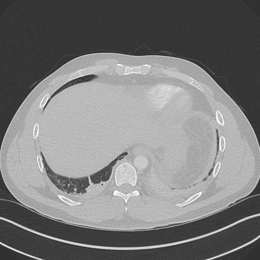 Bilateral atelectasis (Radiopaedia 48666-53675 Axial lung window 92).jpg