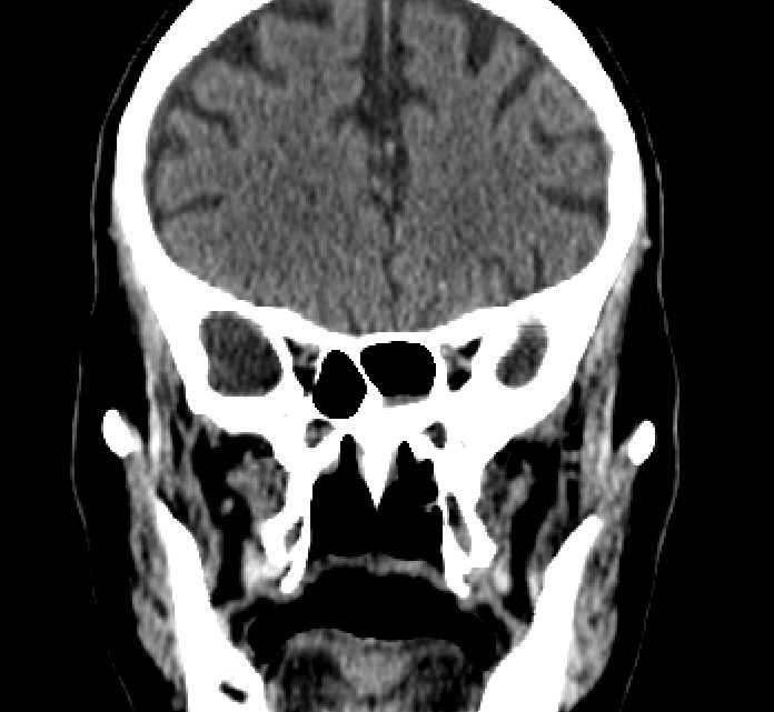 Bilateral ectopia lentis (Radiopaedia 89889-107013 Coronal non-contrast 103).jpg