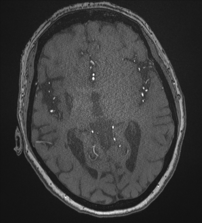 Bilateral fetal posterior communicating arteries (Radiopaedia 41286-44102 Axial MRA 107).png