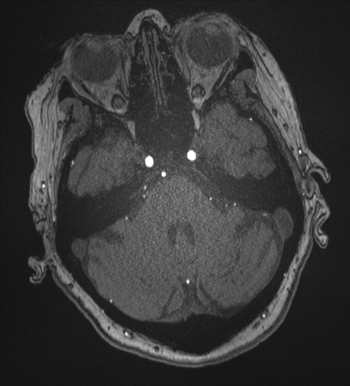 Bilateral fetal posterior communicating arteries (Radiopaedia 41286-44102 Axial MRA 48).png