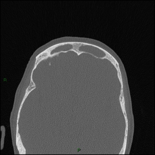 Bilateral frontal mucoceles (Radiopaedia 82352-96454 Axial bone window 92).jpg