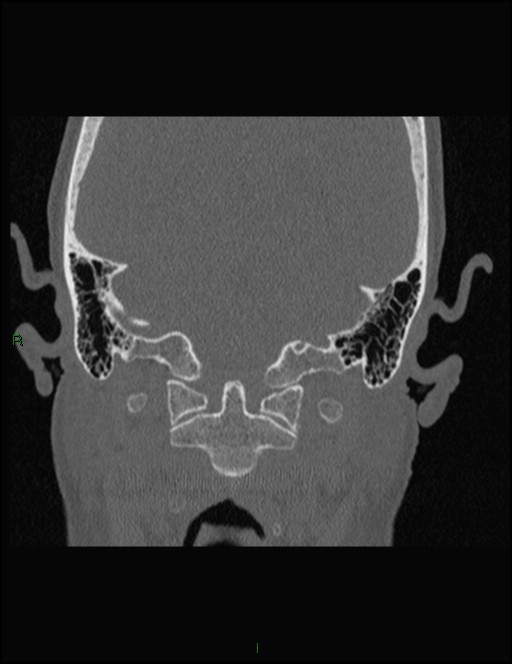 Bilateral frontal mucoceles (Radiopaedia 82352-96454 Coronal 346).jpg