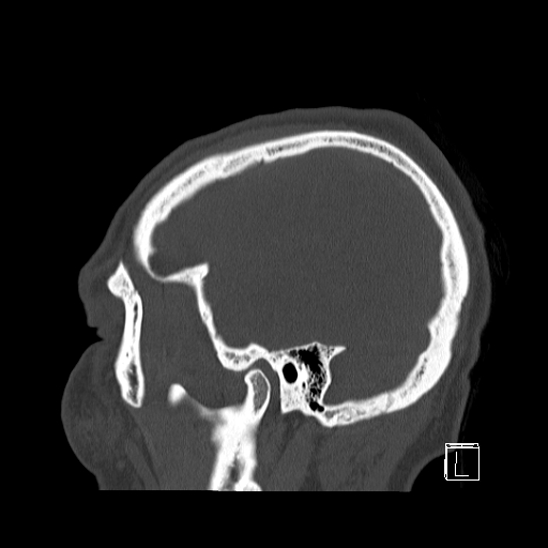 Bilateral occipital condyle fracture (type 2) (Radiopaedia 87675-104089 Sagittal bone window 99).jpg