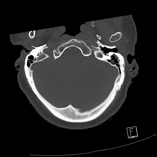 Bilateral occipital condyle fractures (type 3) (Radiopaedia 87672-104086 Axial bone window 4).jpg