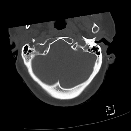 Bilateral occipital condyle fractures (type 3) (Radiopaedia 87672-104086 Axial bone window 7).jpg