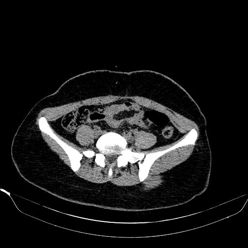 File:Bilateral ovarian dermoid (Radiopaedia 45714-49907 Axial non-contrast 4).JPEG