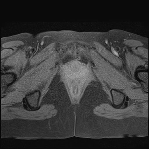 File:Bilateral ovarian endometriomas (Radiopaedia 87085-103347 Axial T1 fat sat 21).jpg